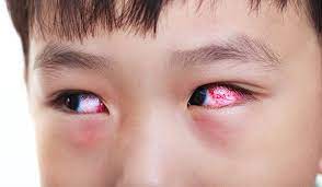 Bệnh đau mắt đỏ điều trị như thế nào? 
