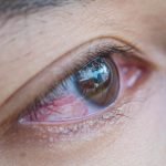 Bệnh đau mắt đỏ, triệu chứng và cách điều trị