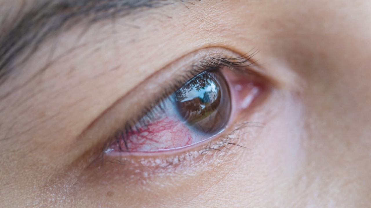 Bệnh đau mắt đỏ có dấu hiệu gì?  